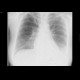 Lung congestion, uremic lung: X-ray - Plain radiograph
